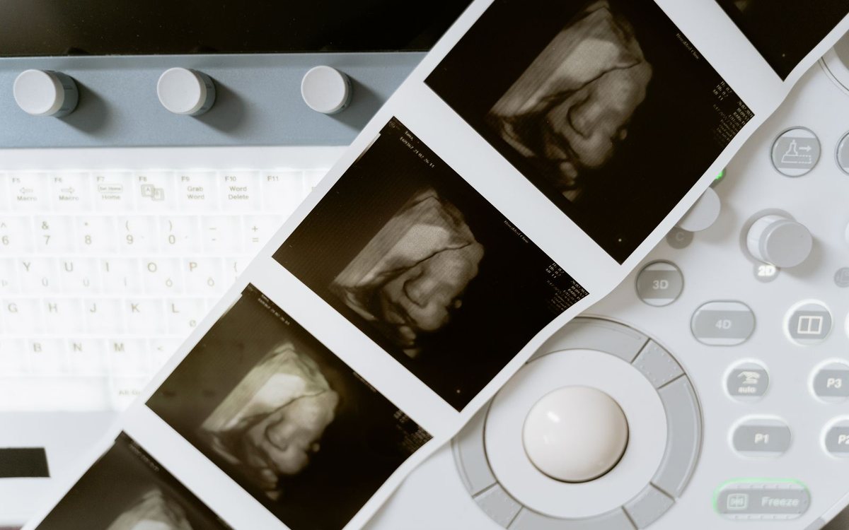 A 3D ultrasound scan printout beside medical equipment