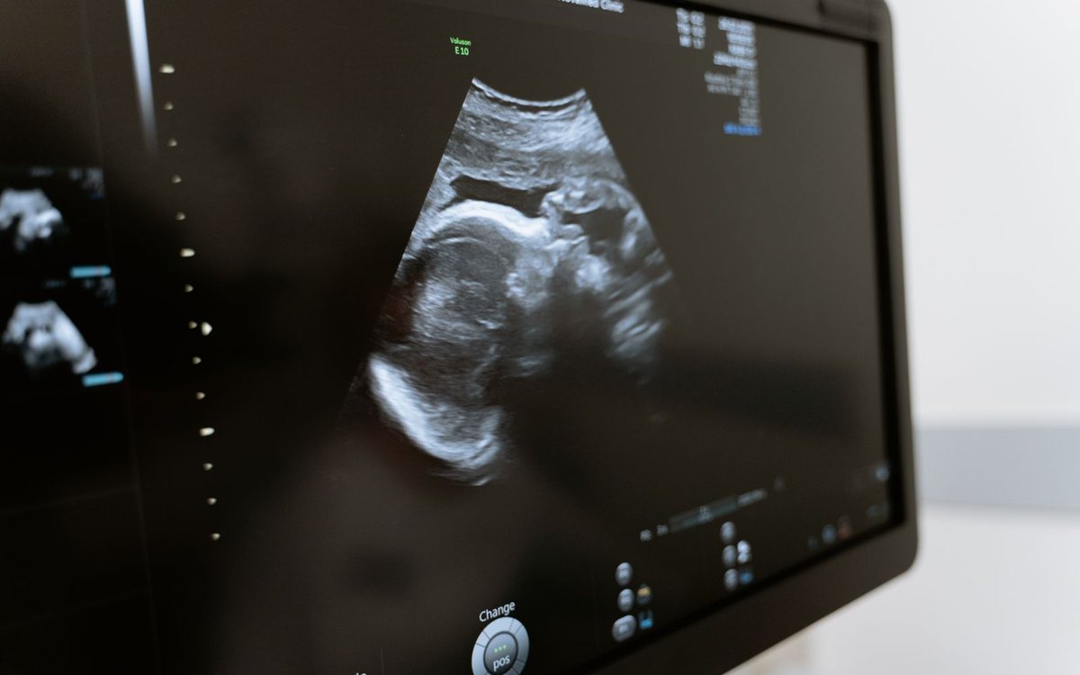 An ultrasound scan showing a fetus on a monitor