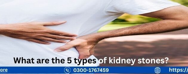 What are the 5 types of kidney stones?